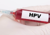 HPV 是炎症还是病毒